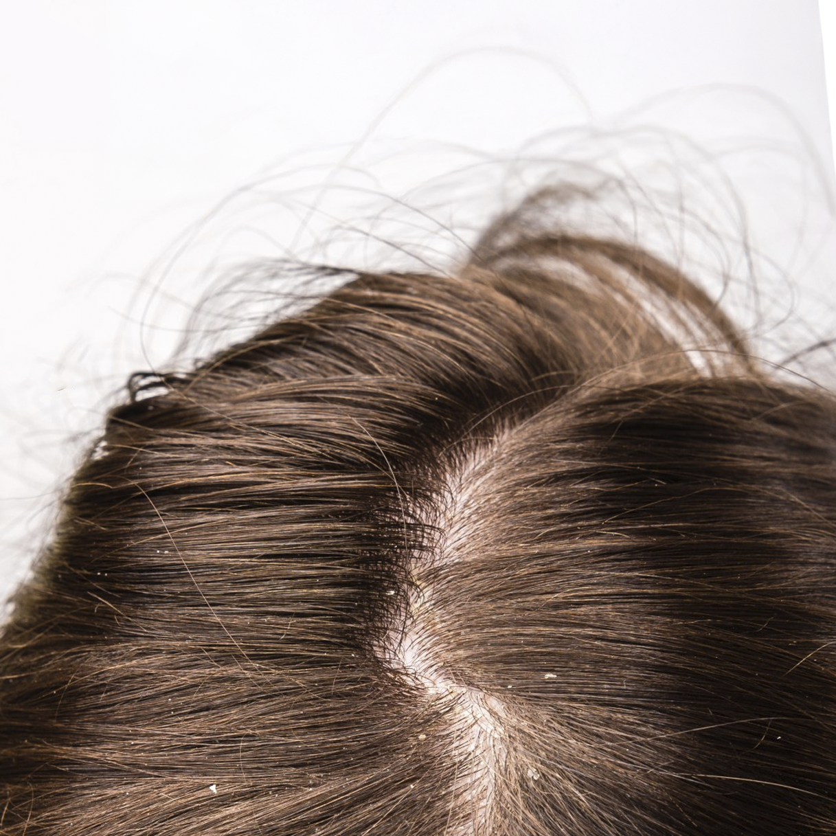 Desconforto do Couro Cabeludo 